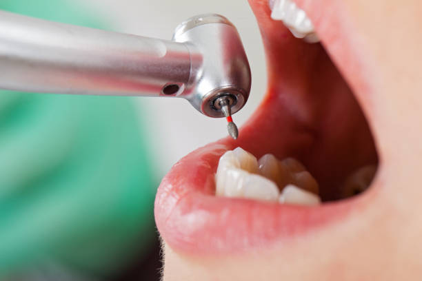 Best Emergency Root Canal Treatment in Taylorsville, MS